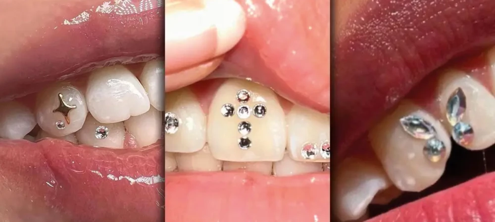 Zahnschmuck von Classic Tattoo - Dein Nr. 1 Walk-In Shop in Berlin und Brandenburg